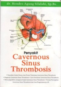 Image of PENYAKIT CAVERNOUS SINUS THROMBOSIS